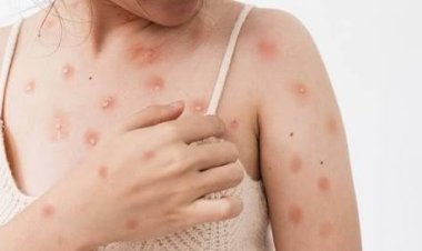 Dinkes Meranti Tegaskan Tidak Ada Penambahan Kasus Cacar Monyet